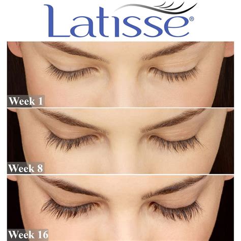 Latisse reviews. Things To Know About Latisse reviews. 